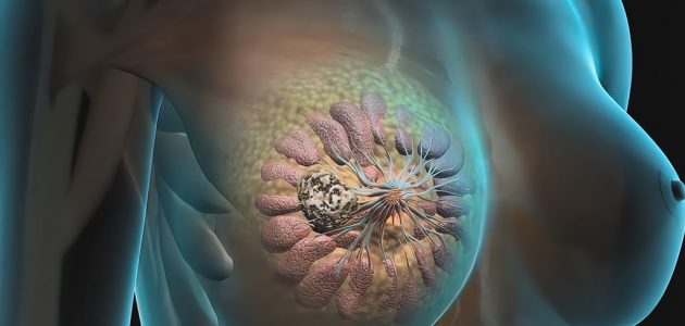 Breast Cancer, Ductal Carcinoma A view into cancerous breast milk ducts. The lobes of the breast are made up of smaller lobules. Breast milk is produced in the lobules and carried to the nipple by milk ducts. 3D illustration
